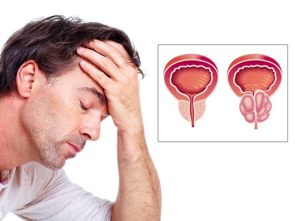 Prostataadenom mit Impotenz